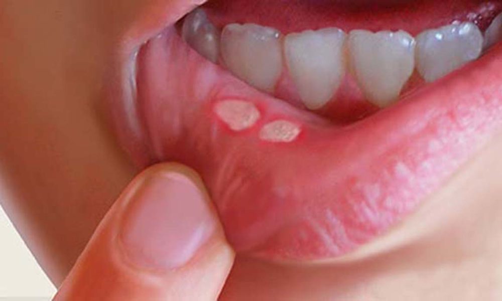 Mouth cancer symptoms on the lip